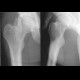 Myositis ossificans, soft tissue calcification: X-ray - Plain radiograph